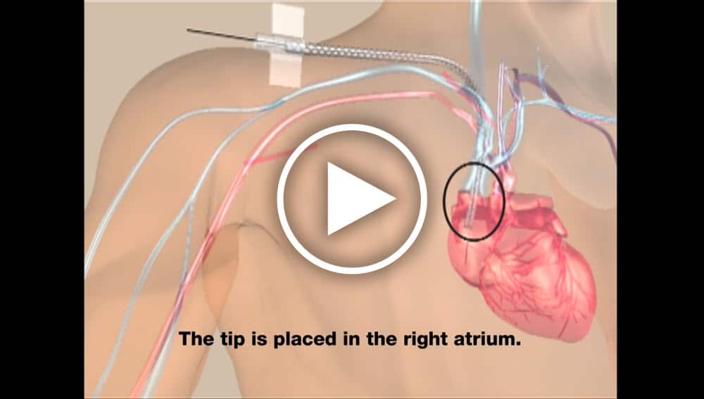 HeRO® Graft Care and Cannulation - Merit Medical HeRO® Graft Care and Cannulation - Merit Medical