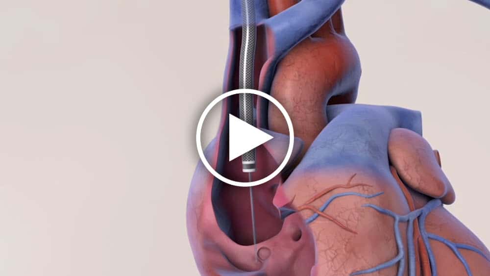 Dr. Jeffrey H. Lawson discusses using the HeRO Graft to reconstruct and salvage a patient’s fistula or AV graft venous outflow that is failing.