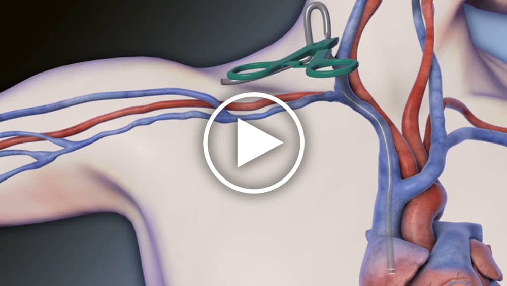 HeRO® Graft Implant Procedure - Merit Medical HeRO® Graft Implant Procedure - Merit Medical