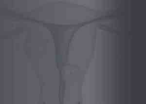 Uterus with Fibroids Present - Fibroid Awareness Month - July