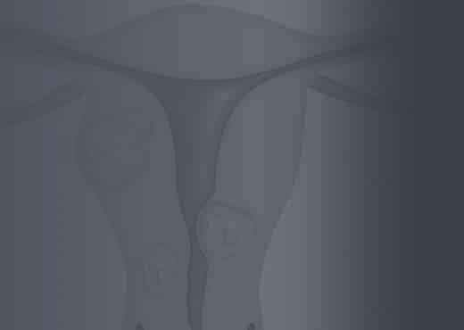 Uterus with Fibroids Present - Fibroid Awareness Month - July