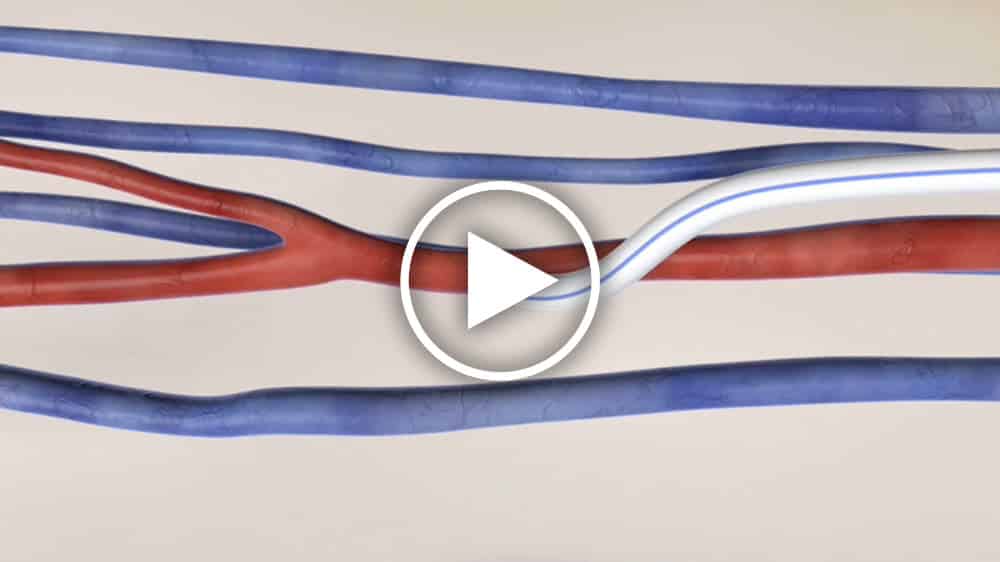 Patients & Caretakers - How HeRO Graft Works