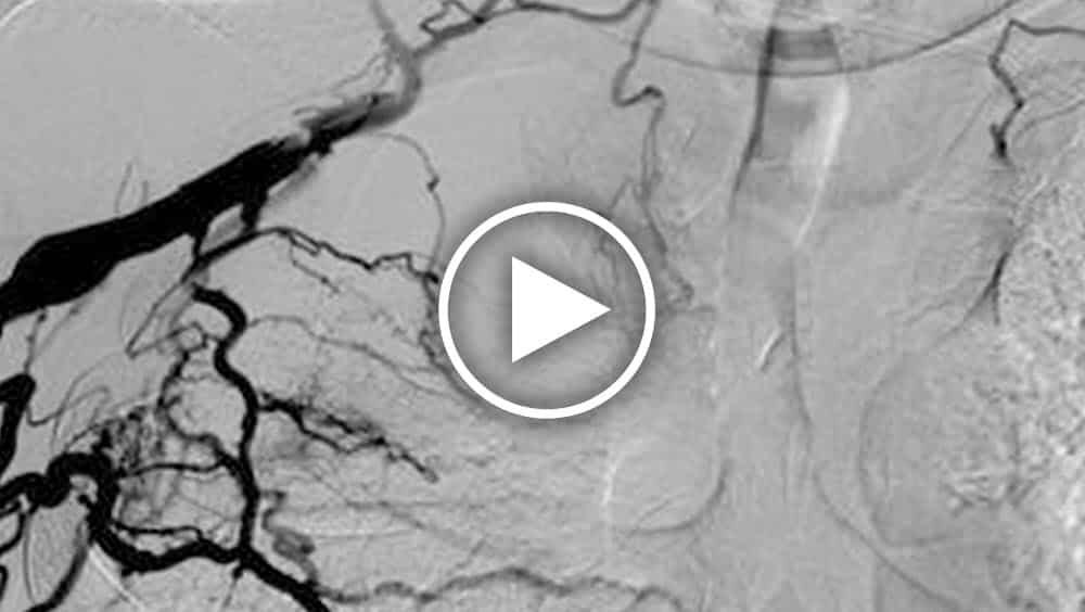 Dr. Jeffrey H. Lawson details the causes of central venous pathology and how the HeRO Graft provides durable treatment outcomes.