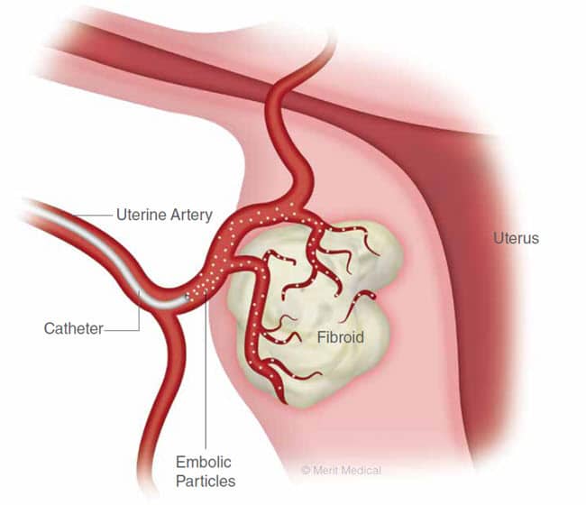 Uterine Fibroid Embolization - Using embolics to treat uterine fibroids