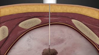 Image of dehydrated plug inserted into pleural space