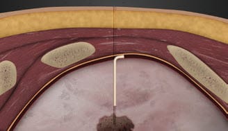 Image of hydrogel plug swelling, creating airtight seal