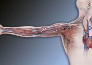 An illustrated look at the HeRO Graft, showing the veins within an arm