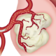 Illustration of a fibroid being treated with embolic agents