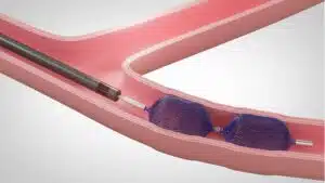 Siege Vascular Plug [In-Service]