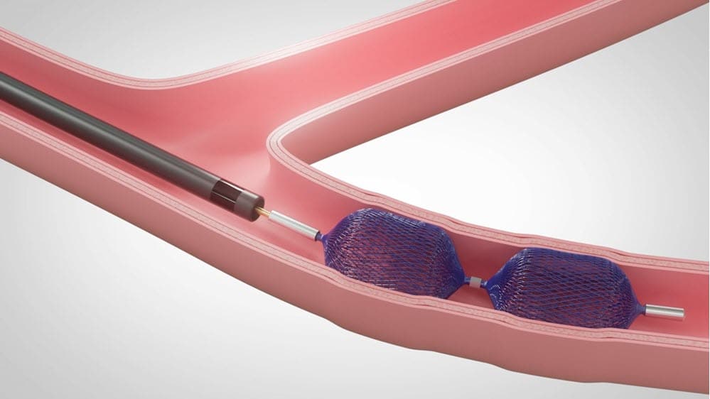 Siege Vascular Plug [In-Service]