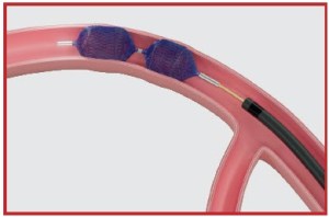 Rapid Occlusion