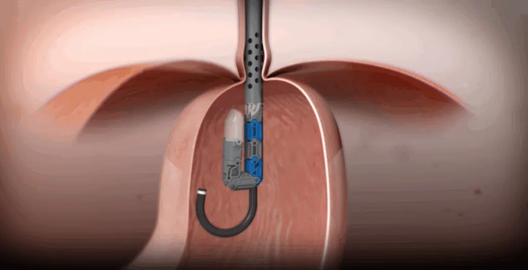 TIF 2.0 procedure in video