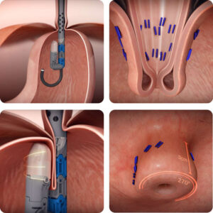 TIF 2.0 procedure snapshots