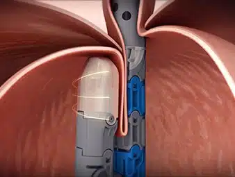 EsophyX Z+ Infomercial 