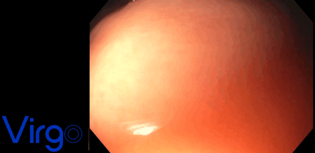 Assessing the GEJ and Evaluating the Hiatus