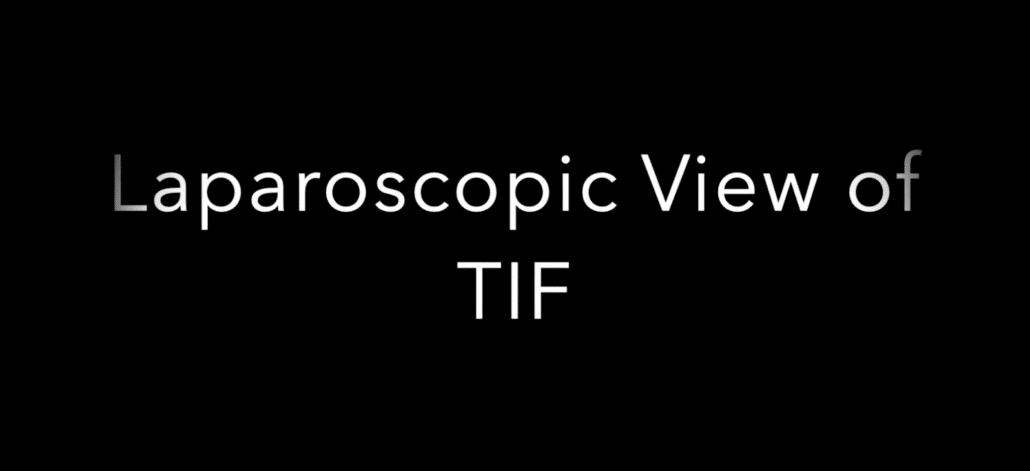 Laparoscopic View of cTIF